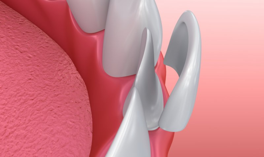 The Enamel Removal Process