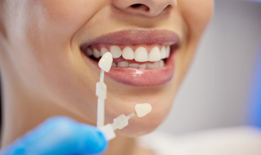 Veneers