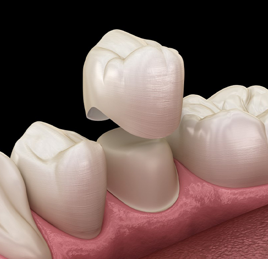 Crown Lengthening in Charlotte, NC - Regal Oaks Dental