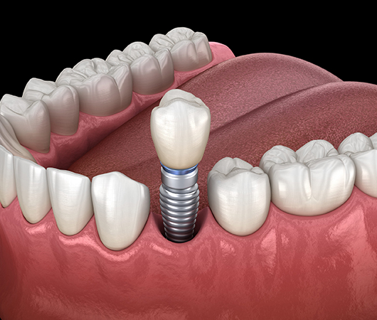 Dental Implants in Charlotte, NC - Regal Oaks Dental