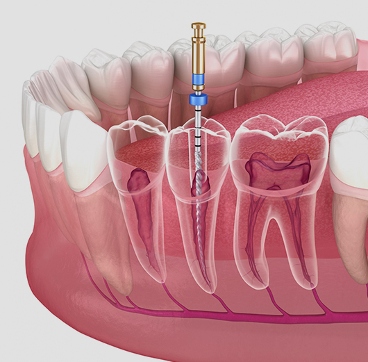 Endodontic Surgery in Charlotte, NC - Regal Oaks Dental