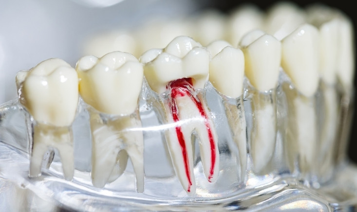 myths about root canals