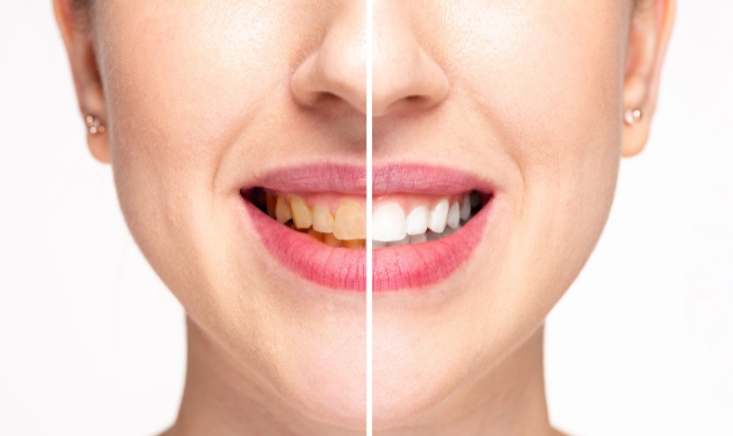 how to achieve a radiant smile with effective teeth whitening treatment
